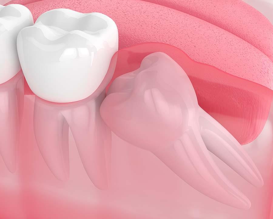 Retinuoto danties rovimas